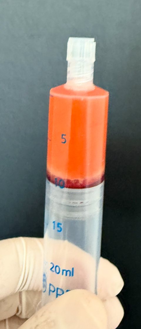 A 20 ml syringe with orange-red plasma above a thin dark sediment