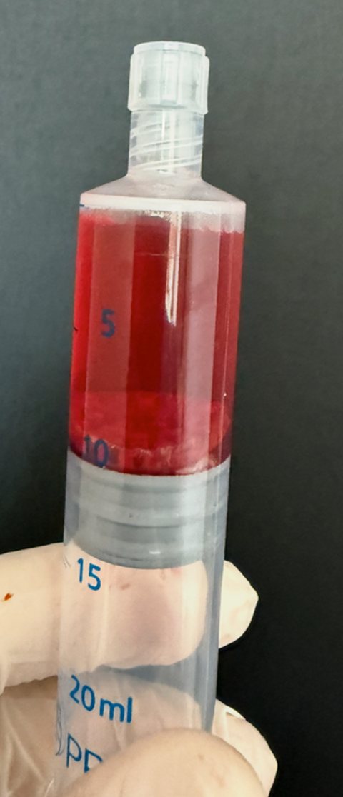 A 20 ml syringe with dark red fluid and a sediment line near the 10 ml mark